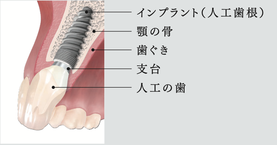 インプラント治療