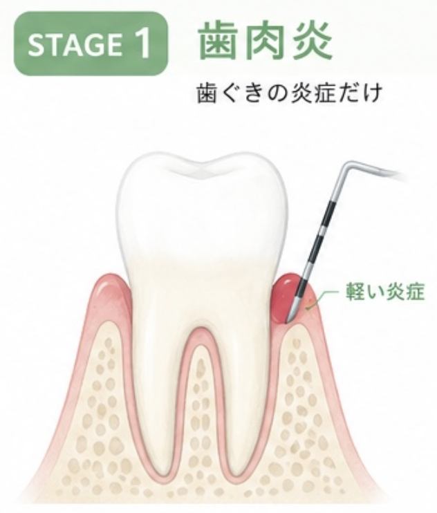 STAGE1 歯肉炎