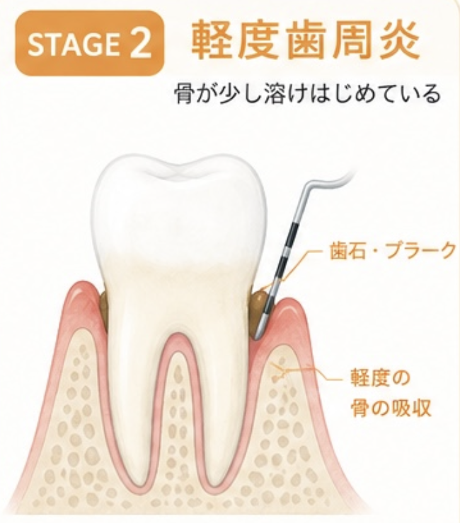STAGE2 軽度歯周炎