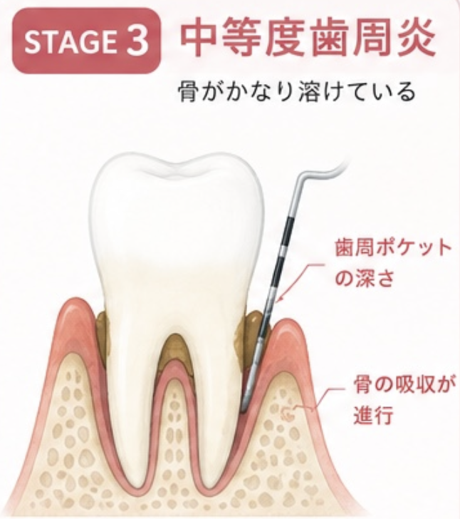 STAGE3 中等度歯周炎