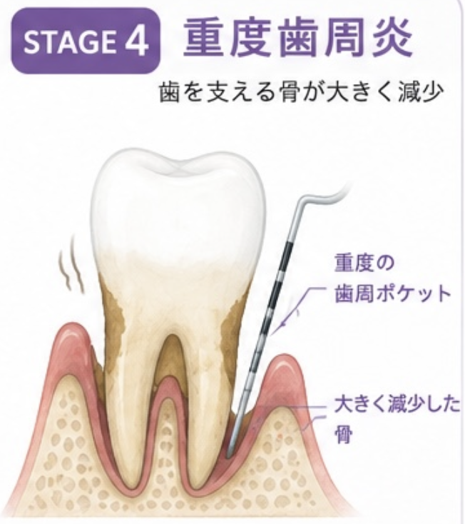STAGE4 重度歯周炎
